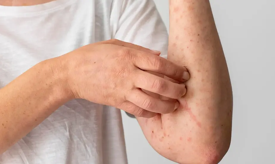 Common Triggers of Allergy