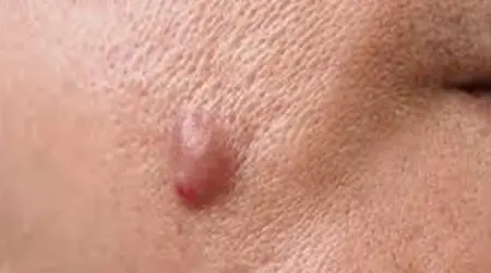 Painful Bumps
