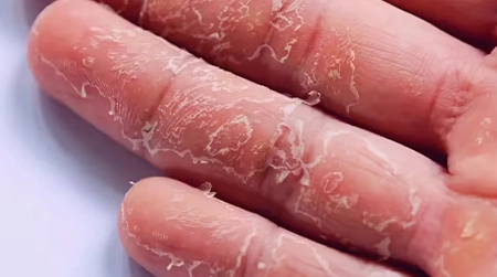 Cracked Skin