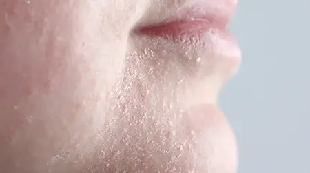 Dry patches