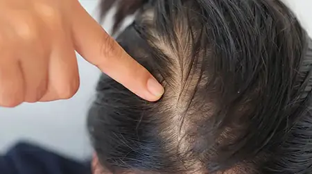 Hair Breakage