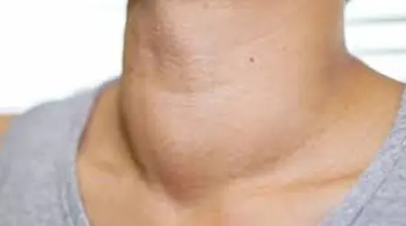 Neck Swelling