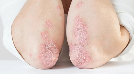 Red Patches