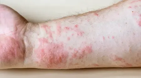 Red rashes