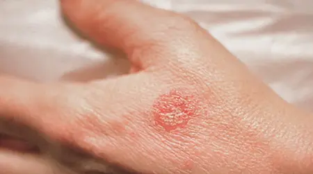 Round Rash