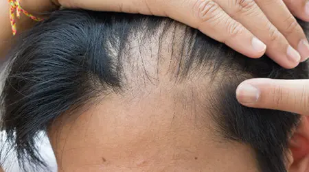 Scalp Itching