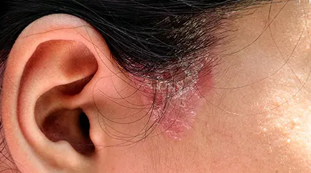 Scaly Skin