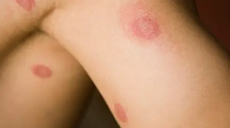 Skin Itching