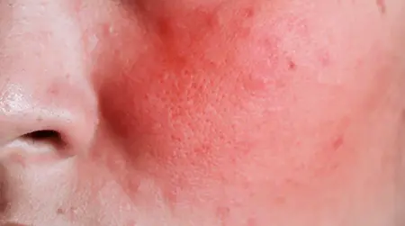 Skin Redness