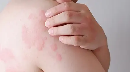 Skin swelling