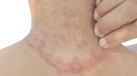 Spreading Patches