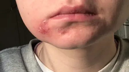 Swollen Spots