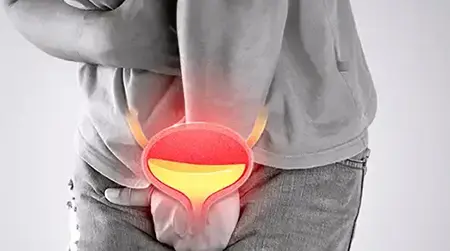 Urine Burning