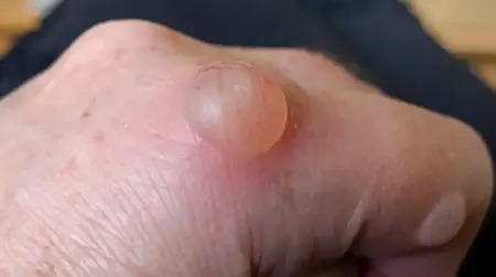 Water Blisters
