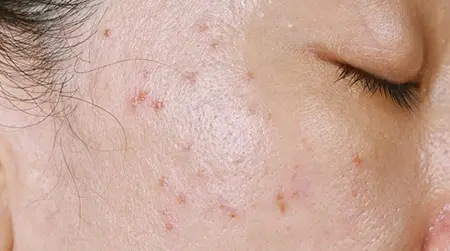 Whiteheads