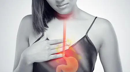 Acid  Reflux