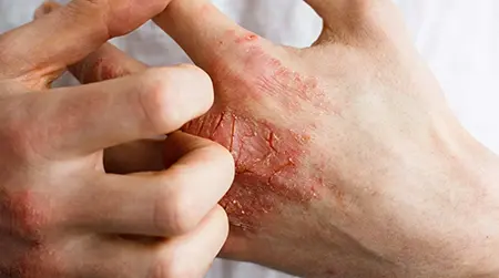 Atopic  Dermatitis