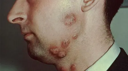 Beard Ringworm