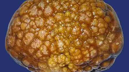 Cholesterol Stones