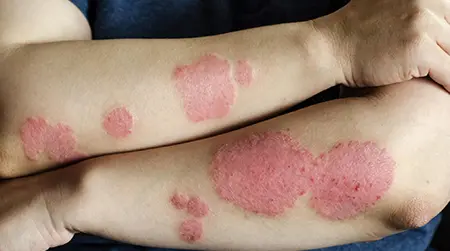 Contact  Dermatitis