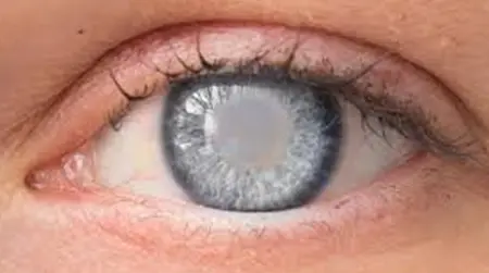 Cortical Cataract