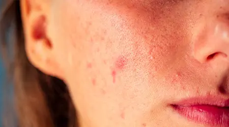 Cosmetic  Allergy
