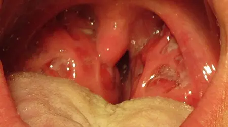 Cryptic Tonsillitis