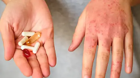 Drug   Allergy