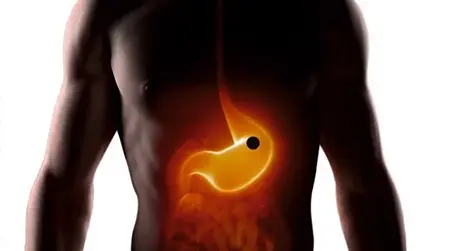 Duodenal Ulcer