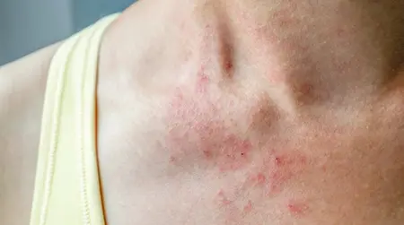 Dust   Allergy