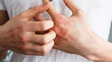 Eczema  Allergy