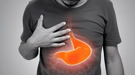 Esophageal Ulcer