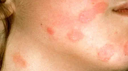 Face Ringworm