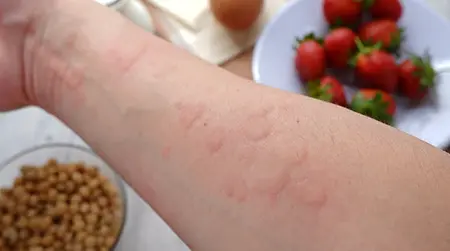 Food   Allergy