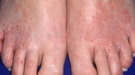 Foot Ringworm