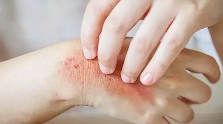 Fungal  Allergy