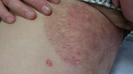 Groin Ringworm