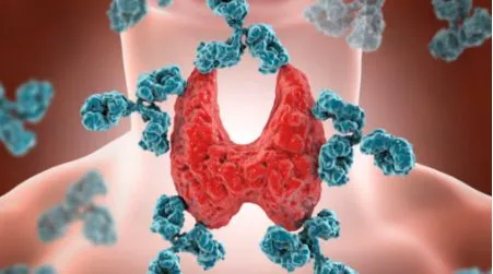 Hashimoto Disease