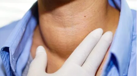 Hyperthyroidism