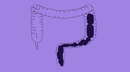 IBS-C Type