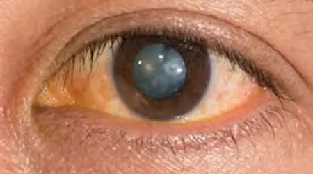 Nuclear Cataract
