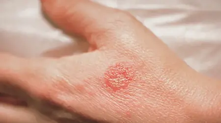 Nummular  Eczema