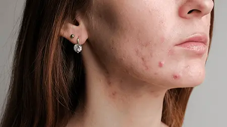 Papular Acne