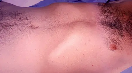 Paratyphoid Fever