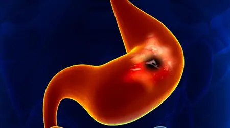 Peptic Ulcer