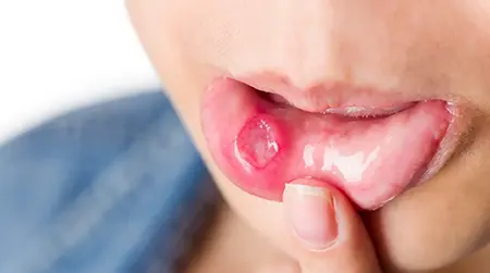 Refractory Ulcer