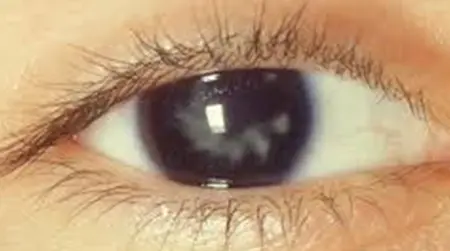 Secondary Cataract