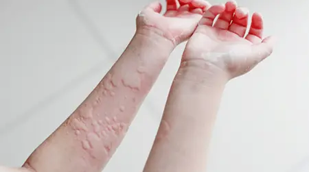 Skin  Allergy