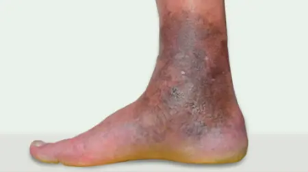 Stasis  Dermatitis