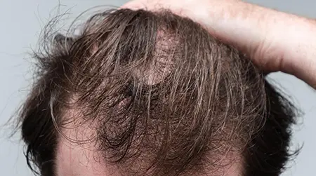 Telogen Effluvium